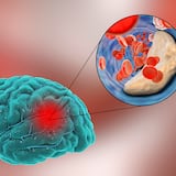 Trombectomía mecánica: procedimiento efectivo para tratar el ictus isquémico