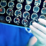 Lo que debes saber sobre el ataque cerebral o “stroke”