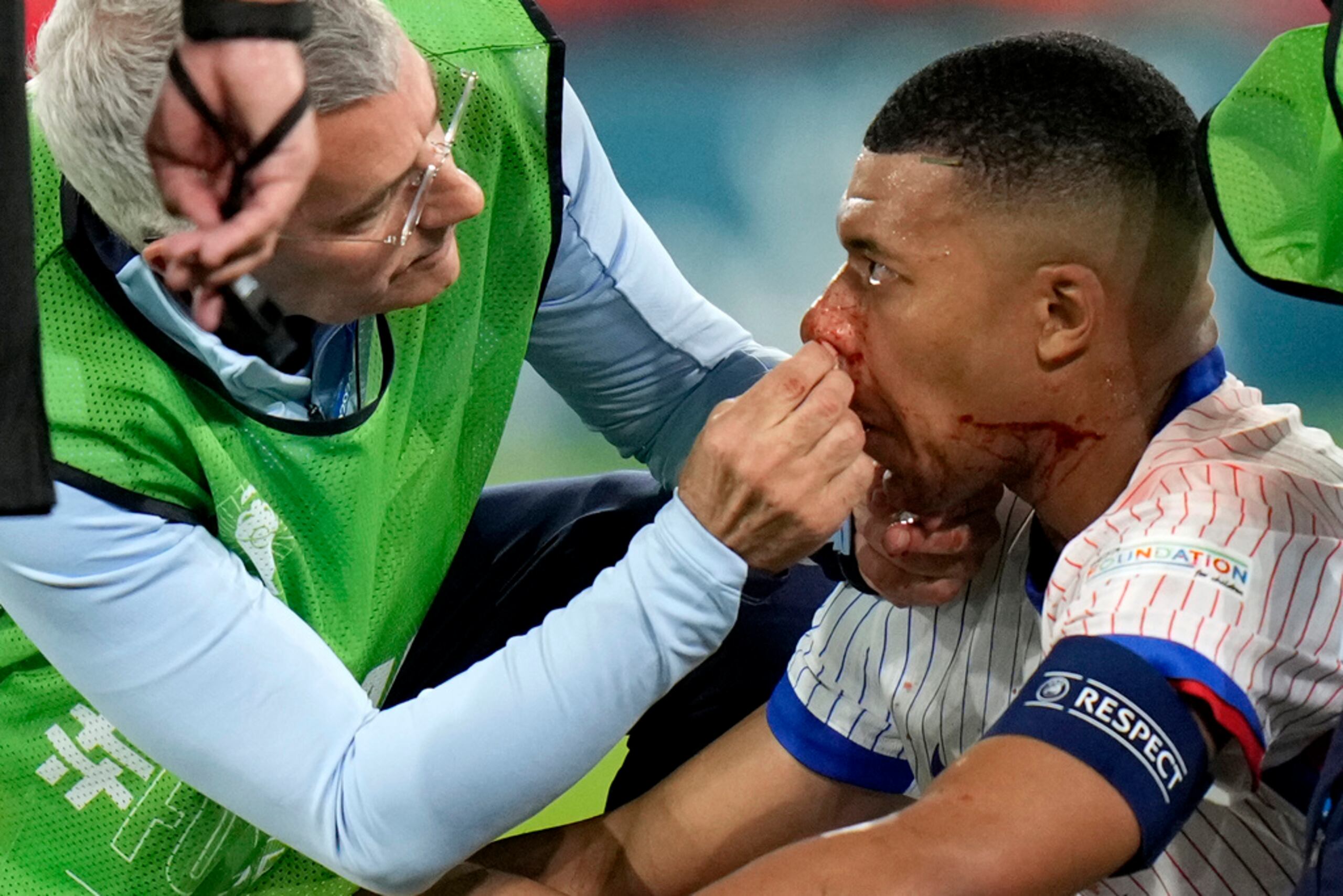 Kylian Mbappé recibe tratamiento después de lastimarse la nariz durante el juego entre Francia y Austria.